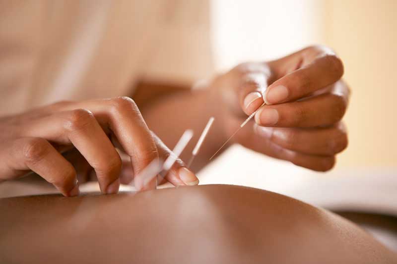 Dry needling som utförs